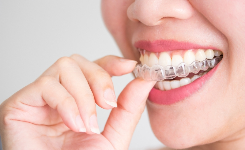 Braces and Clear Aligners_ Achieving Straighter Smiles with Modern Orthodontic Solutions