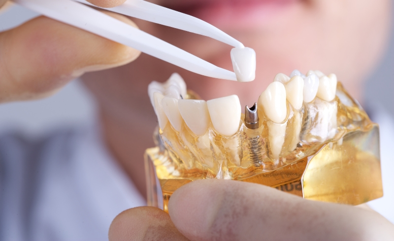 Dental Implants_ The Ultimate Solution for Missing Teeth