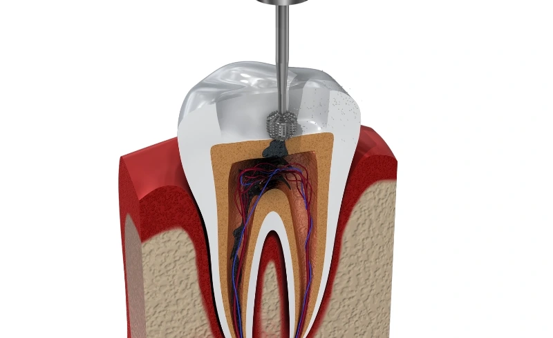 Demystifying Root Canal Treatment_ Saving Your Natural Tooth with Confidence